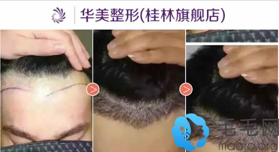 桂林华美女性发际线过高植发2000单位30天效果