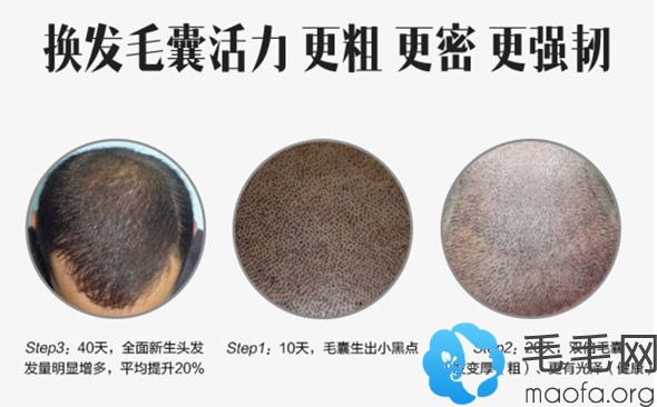 太原华美种植头发第10天，20天和40天的效果