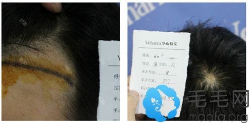 在郑州华山医院做植发前的照片