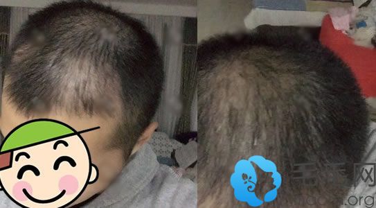 上海华美植发2个月效果图