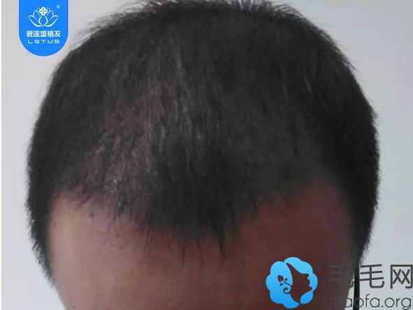深圳种植头发三个月的效果怎么样