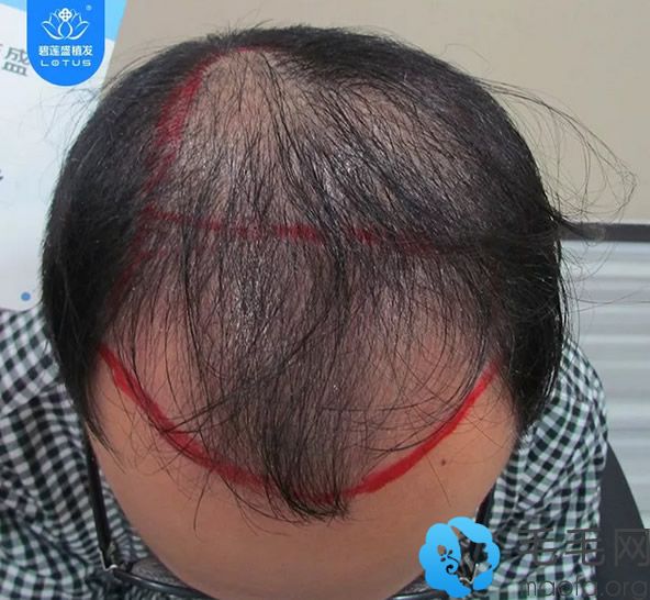 深圳碧莲盛医院种植头发前照片
