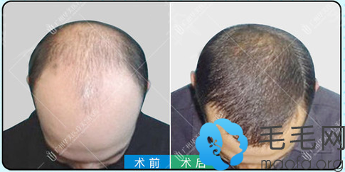 佛山植发华美不错(佛山植头发一般价格多少)