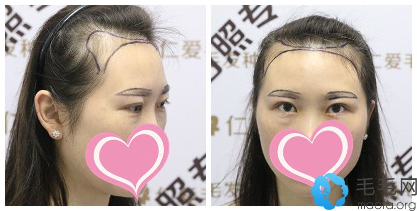 32天前我在武汉仁爱医院做了发际线+眉毛种植,现处于脱落期