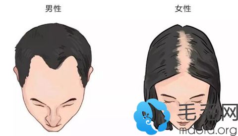 头发种植技术