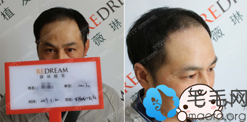 我找北京薇琳植发窦云轲做发际线种植+头顶加密一个月了