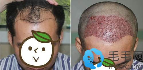 植发手术前和植发手术后即刻对比