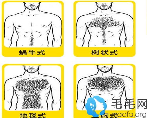 胸毛种植的几种常见类型