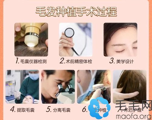 郑州辰星植发手术流程步骤