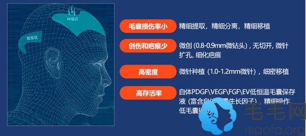 广州军美PDS4.0植发技术优势