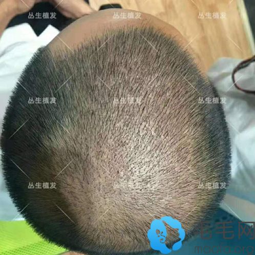 潮汕哪里有植发(汕头哪里有种植头发的)