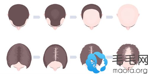毛发移植手术的原理过程
