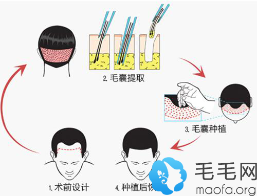 发际线种植手术过程原理