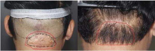 大连京城疤痕植发效果图片解惑25年的头部烫伤能植发吗？
