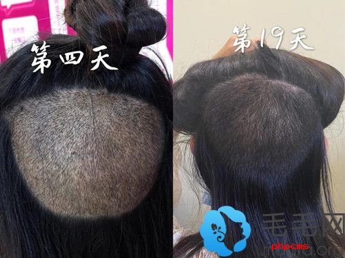 植发后枕部恢复记录吐槽植发后后脑勺取发区刺痛了15天