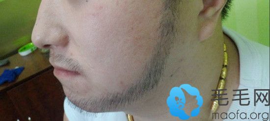植连鬓胡后6个月效果图