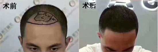 深圳新生3D头发加密种植案例效果