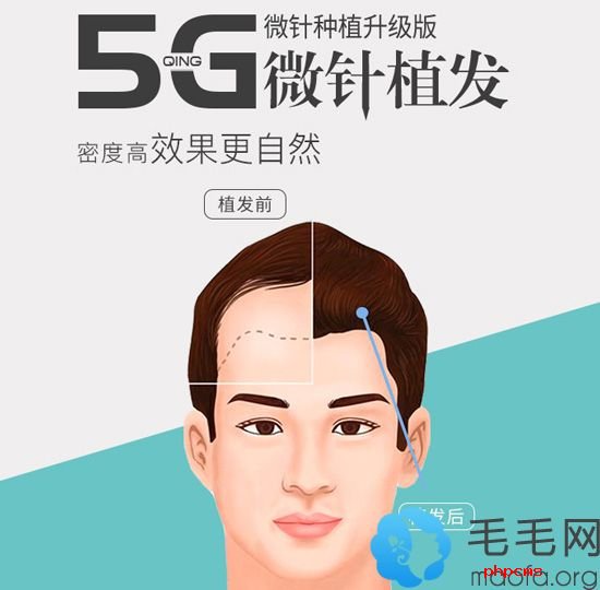 深圳青逸5G微针植发技术