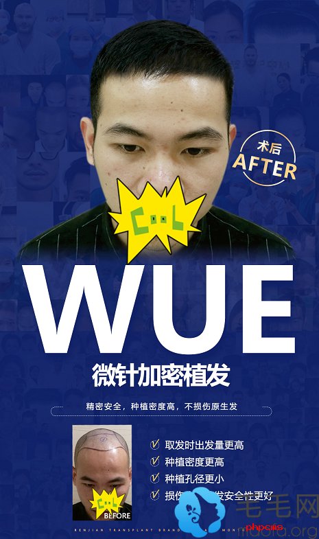广州仁健WUE四维加密植发技术优势