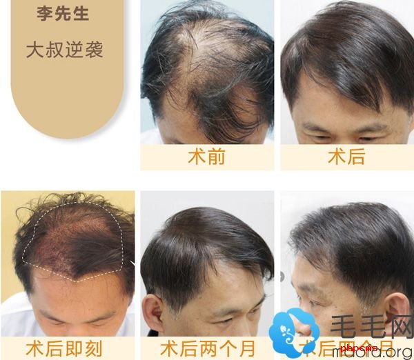 郑州集美头顶头发加密种植术前术后效果对比图