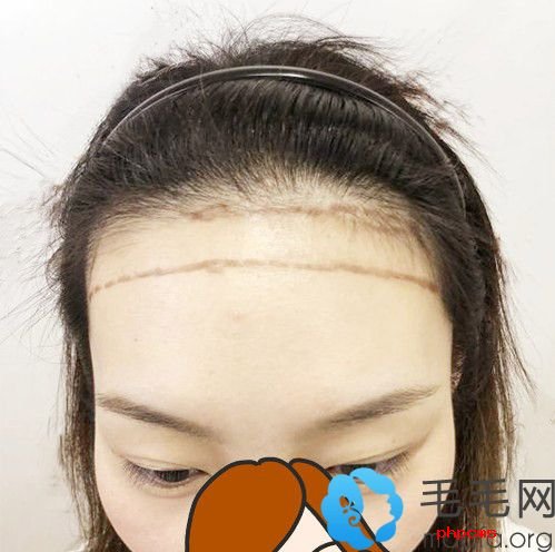 圆形发际线适合什么脸型?