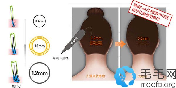 广州肤康植发科毛囊提取速度快创伤小