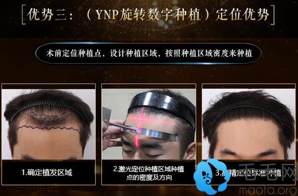 广州肤康植发科激光定位技术