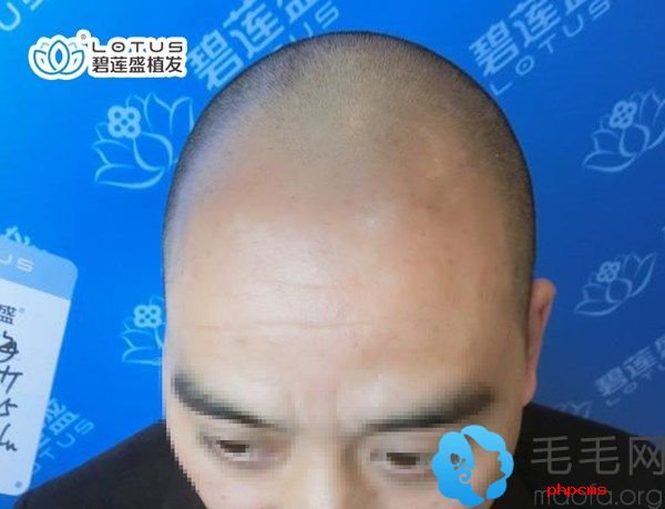 天生额头两边没头发可以用bht植发技术让发际线恢复正常哦!