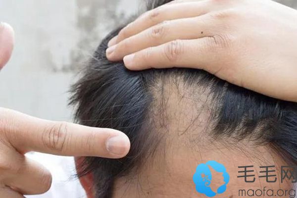 专业治疗不同原因导致的脱发