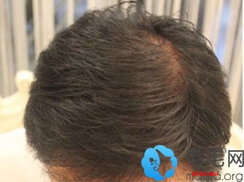 苏州肤康通过植发治疗脂溢性脱发的效果