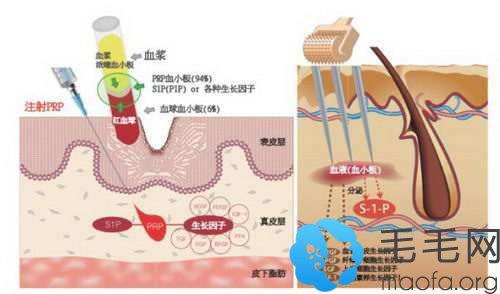 郑州肤康采用自体活细胞增加毛囊成活率
