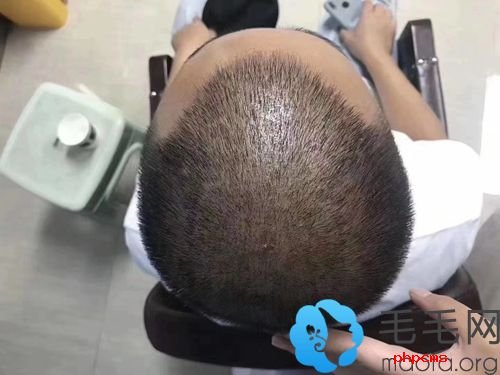 微针植发多少钱一单位?在广州越秀区的新生植发做贵吗?
