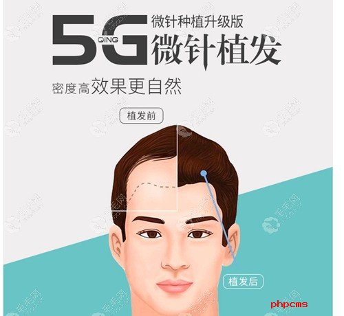 深圳青逸5G植发技术
