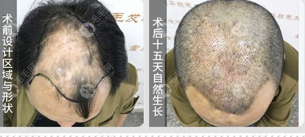 院内疤痕植发前后效果对比