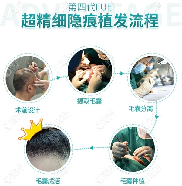 广州荔医植发手术流程