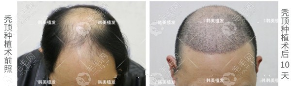 海南植发案例:分享40岁刘先生做秃顶植发六个月的效果图片