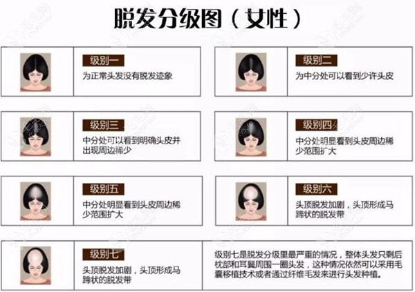 目前植发技术分类(目前植发技术是什么)