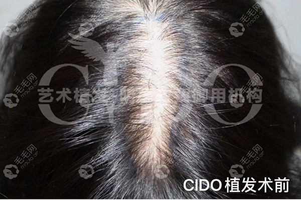 女性头顶稀疏植发成功案例,北京熙朵这头发移植效果可靠!