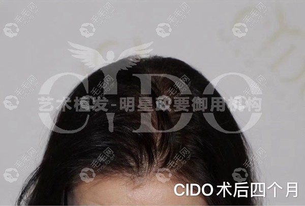 女性头顶稀疏植发四个月效果图