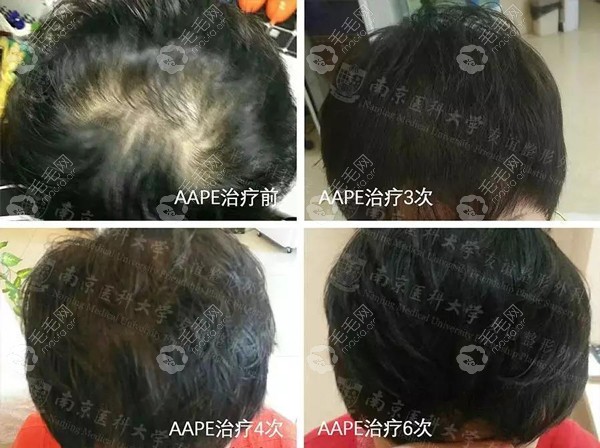 南京友谊医院AAPE头发再生疗法治疗6次的效果