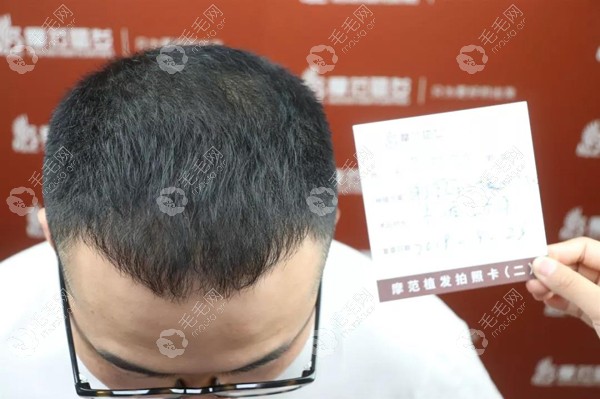 宁波摩范植发专科医院头发加密4090单位的植发效果曝光了