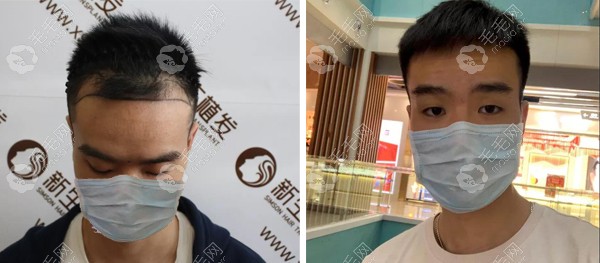 南方医科植发(南方医科大学附属医院植发)