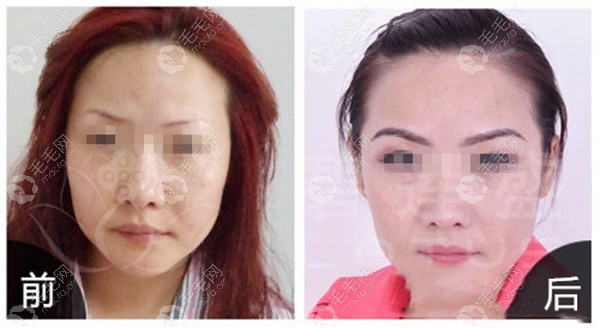 剧透广州碧莲盛的植眉价格!这些种植眉毛对比图片也公开了!