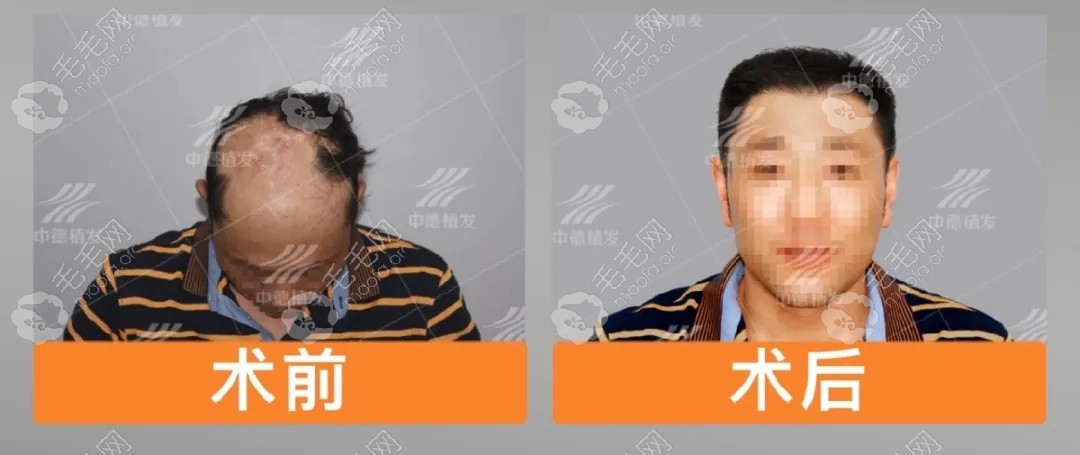 在北京中德毛发医院做疤痕植发的价格是多少钱?效果怎么样?