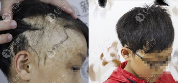 北京新生头部疤痕植发图片
