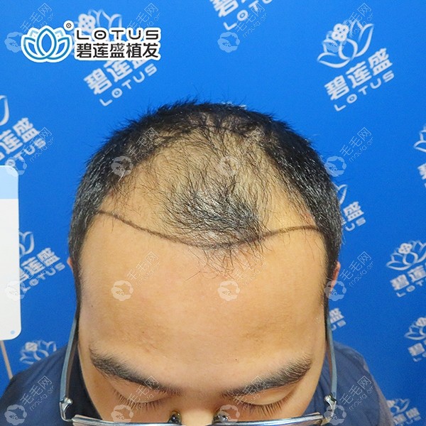 我是4级脱发来看我在海口碧莲盛植发3000单位一年的效果图