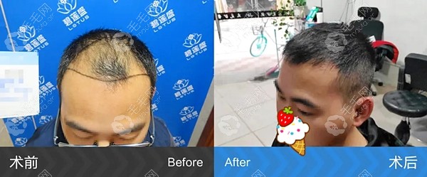 4级脱发之前的样子，和植发后的改变