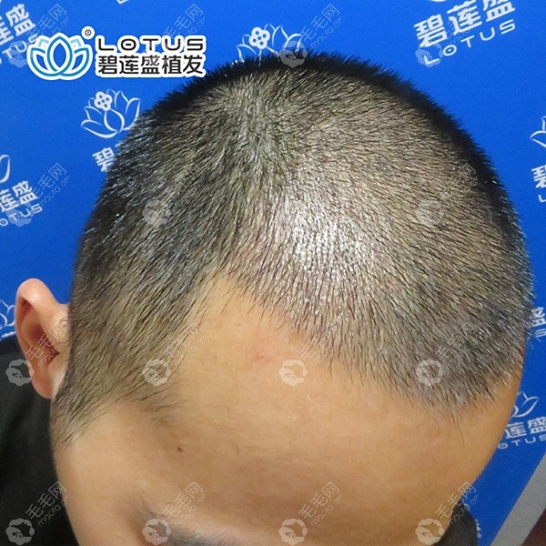 4级脱发植发17天后,用了3000毛囊