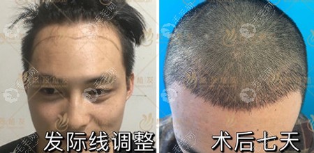 福州真格根源植发案例：男士头顶加密植发的效果图片