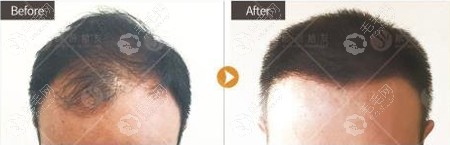 福州根源男士头顶加密种植3000毛囊单位的术前术后对比图